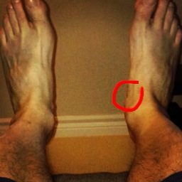 The area circled in red is where the pain was focused.  If you look closely you'll still see a small mysterious bump that isn't present on the left foot.